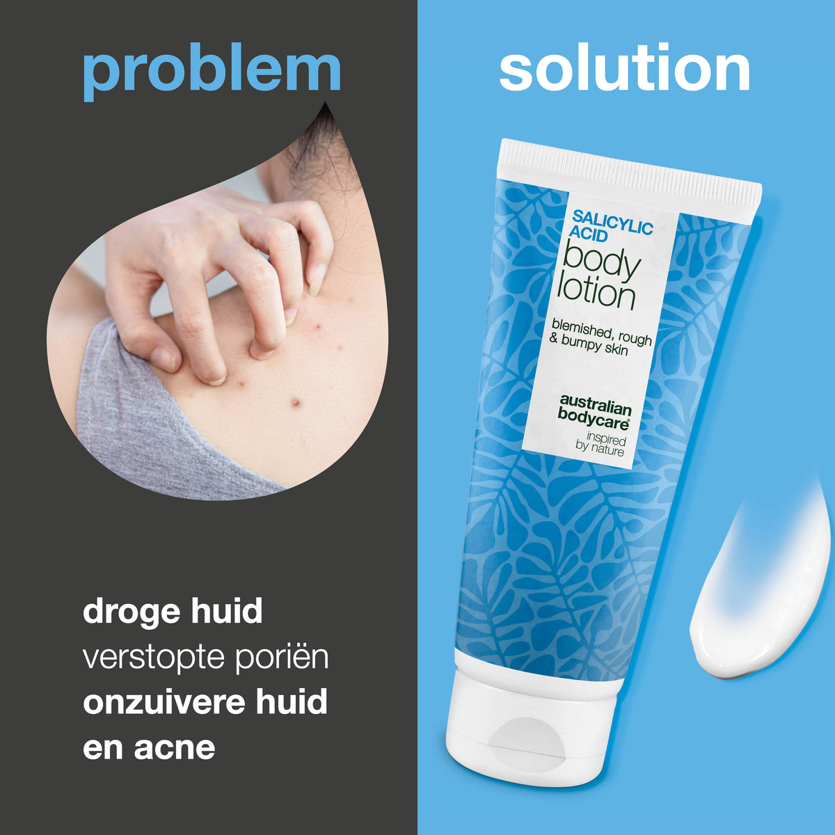 Body Lotion met salicylzuur – tegen onzuiverheden en droge huid —  Body Lotion met salicylzuur exfolieert, hydrateert en helpt bij onzuiverheden, ruwe en droge huid. Perfect voor dagelijks gebruik.