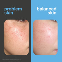 Salicylzuur serum voor mee-eters, vette huid en verstopte poriën — Salicylzuur serum bij vette huid, mee-eters en poriën. Met Zinc PCA, groene thee, hyaluronzuur en hydraterende glycerine.