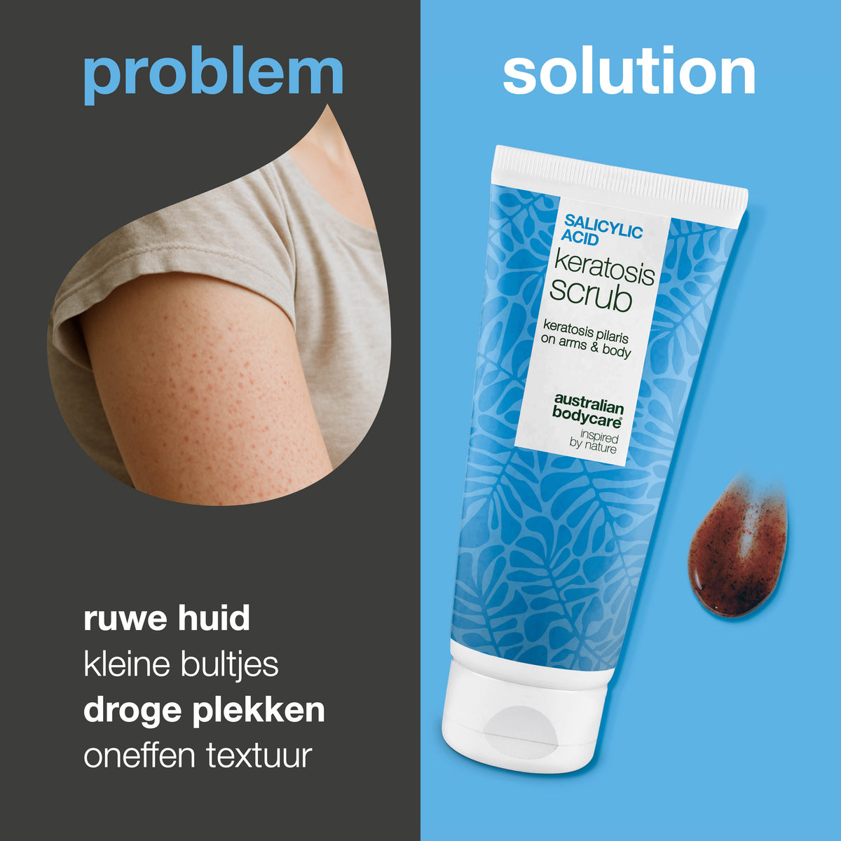 Keratosis Pilaris Lichaamsscrub tegen ruwe, bobbelige huid — Keratosis Pilaris Body Scrub tegen ruwe huid en bultjes. Exfolieert en verzacht met salicylzuur, glycolzuur en glycerine.
