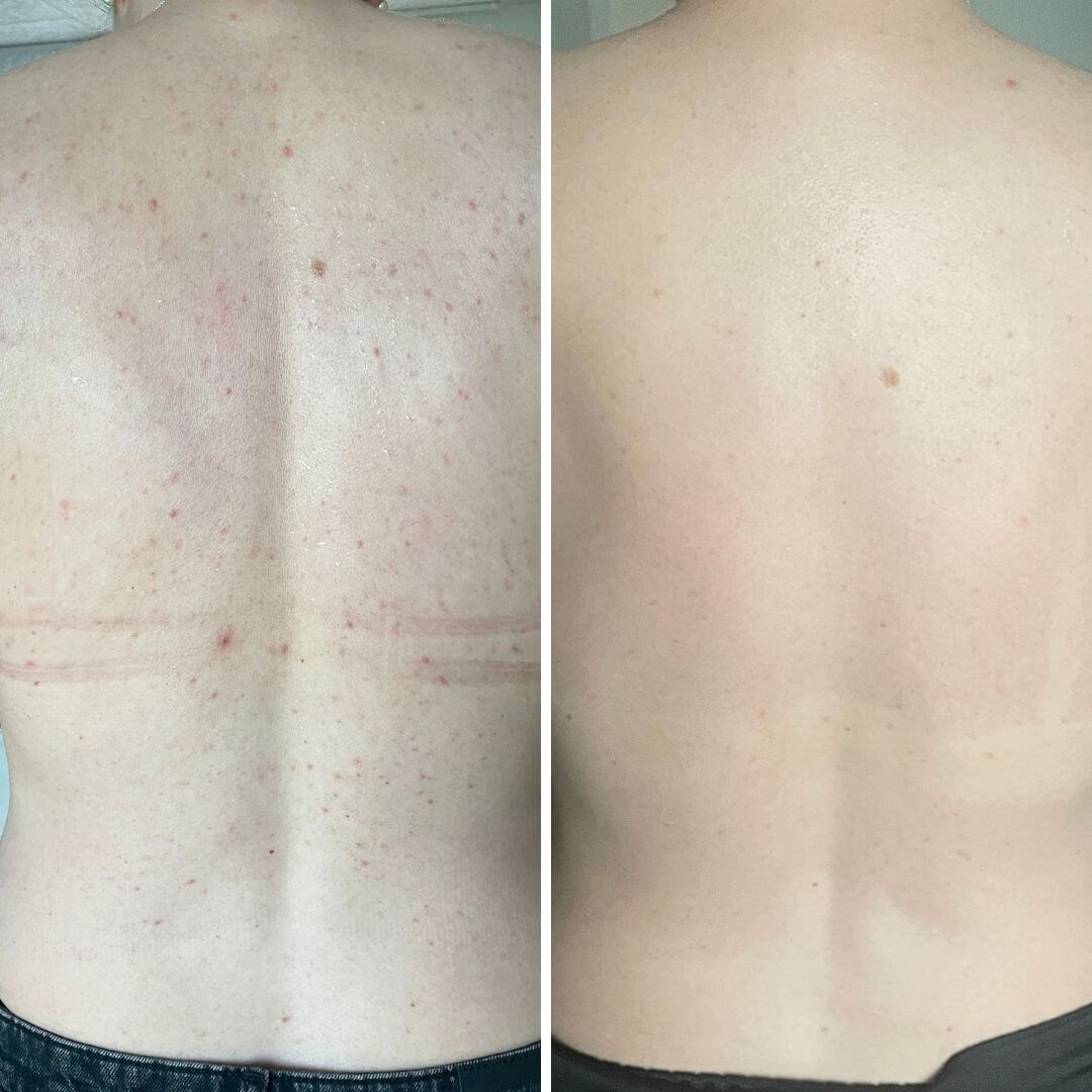 Salicylzuur spray tegen puistjes en verstopte poriën — Salicylzuur spray tegen puistjes en onzuiverheden. Met salicylzuur en glycolzuur voor diepe reiniging en gladde huid.